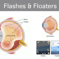 Flashes & Floater