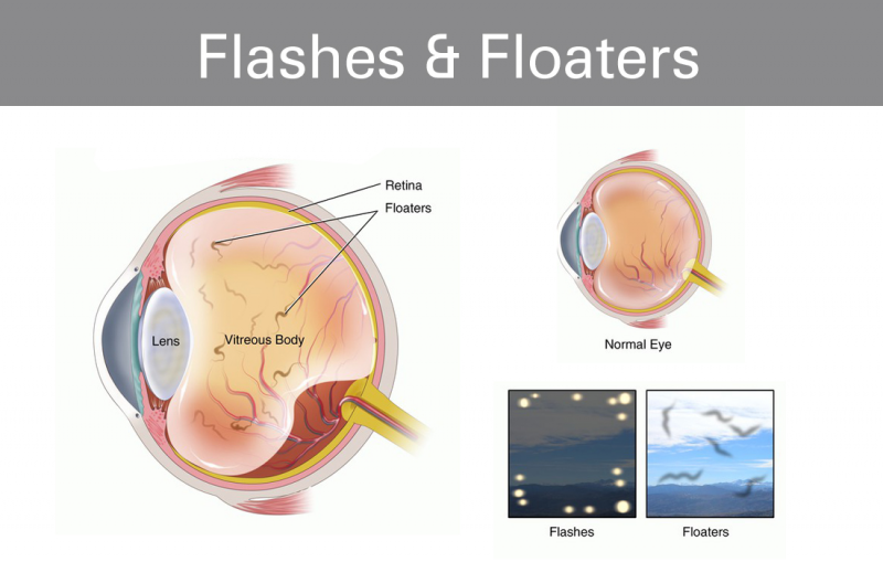 Flashes and Floaters Pediatric Family Eyecare